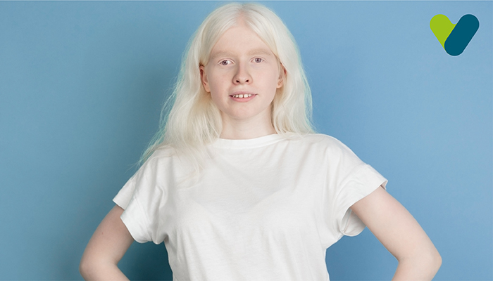 albinism-causes-symptoms-treatment-of-albinism-livlong